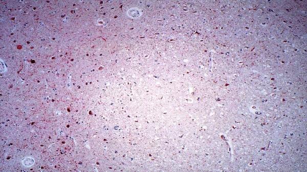 Qué es el virus Nipah: el patógeno sin vacuna que mantiene en alerta a India - Sin vacuna y con tratamiento solo de soporte