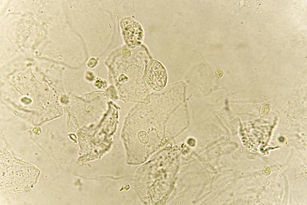 Células epiteliales: qué son, funciones y tipos - Células epiteliales en la orina